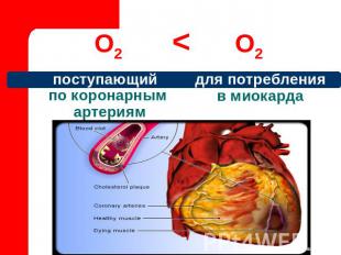 О2 < О2 поступающий по коронарным артериям для потребления в миокарда