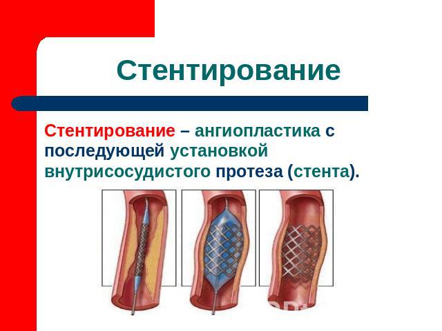 Стентирование Стентирование – ангиопластика с последующей установкой внутрисосудистого протеза (стента).