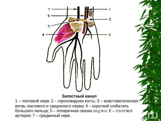 Запястный канал1 – локтевой нерв; 2 – гороховидная кость; 3 – анастомотическая ветвь локтевого и срединного нерва; 4 – короткий сгибатель большого пальца; 5 – поперечная связка ладони; 6 – локтевая артерия; 7 – срединный нерв.