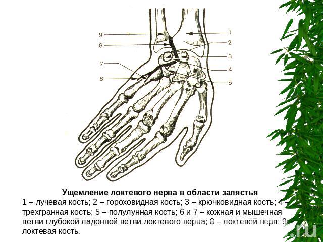 Ущемление локтевого нерва в области запястья1 – лучевая кость; 2 – гороховидная кость; 3 – крючковидная кость; 4 – трехгранная кость; 5 – полулунная кость; 6 и 7 – кожная и мышечная ветви глубокой ладонной ветви локтевого нерва; 8 – локтевой нерв; 9…