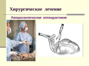 Хирургическое лечение Лапароскопическая аппендэктомия