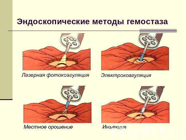 Эндоскопические методы гемостаза