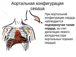 Аортальная конфигурация сердца При аортальной конфигурации сердца наблюдается по