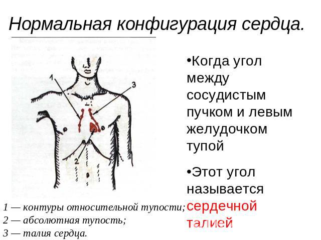 Нормальная конфигурация сердца. Когда угол между сосудистым пучком и левым желудочком тупойЭтот угол называется сердечной талией 1 — контуры относительной тупости; 2 — абсолютная тупость; 3 — талия сердца.