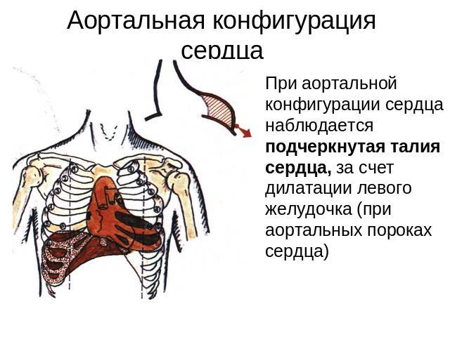 Аортальная конфигурация сердца При аортальной конфигурации сердца наблюдается подчеркнутая талия сердца, за счет дилатации левого желудочка (при аортальных пороках сердца)
