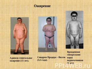 Ожирение Адипозо-генитальноеожирение (15 лет). Синдром Прадера – Вилли(3,5 года)