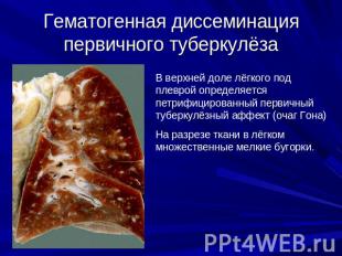 Гематогенная диссеминация первичного туберкулёза В верхней доле лёгкого под плев