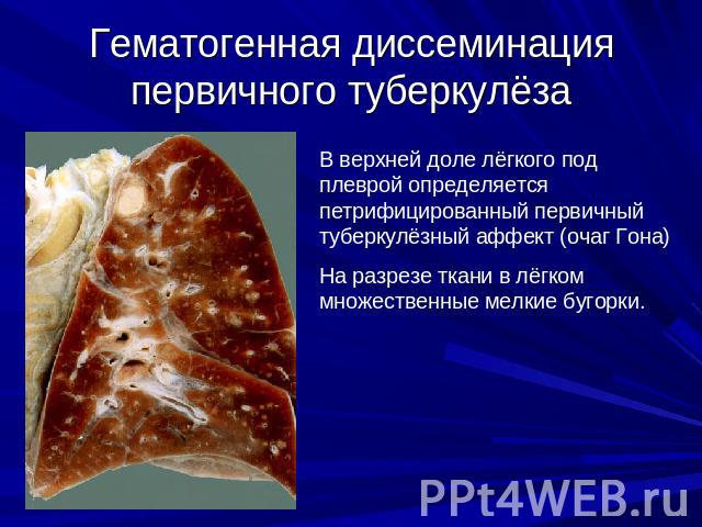 Гематогенная диссеминация первичного туберкулёза В верхней доле лёгкого под плеврой определяется петрифицированный первичный туберкулёзный аффект (очаг Гона)На разрезе ткани в лёгком множественные мелкие бугорки.