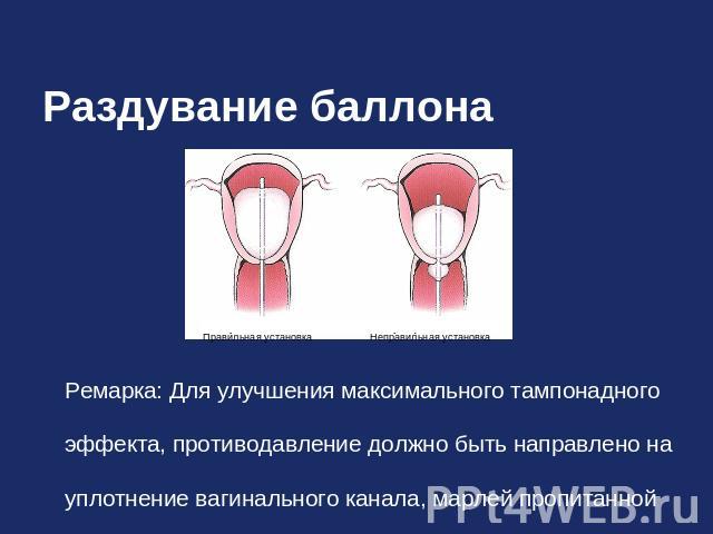 Раздувание баллона Ремарка: Для улучшения максимального тампонадного эффекта, противодавление должно быть направлено на уплотнение вагинального канала, марлей пропитанной йодом или антибиотиками.