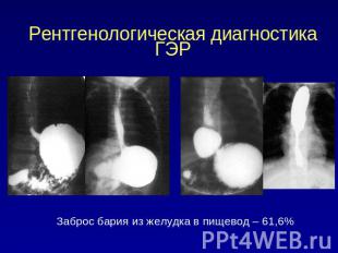 Рентгенологическая диагностика ГЭР Заброс бария из желудка в пищевод – 61,6%
