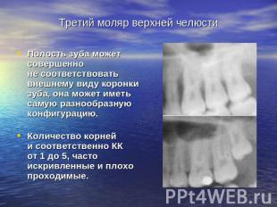 Третий моляр верхней челюсти Полость зуба может совершенноне соответствовать вне