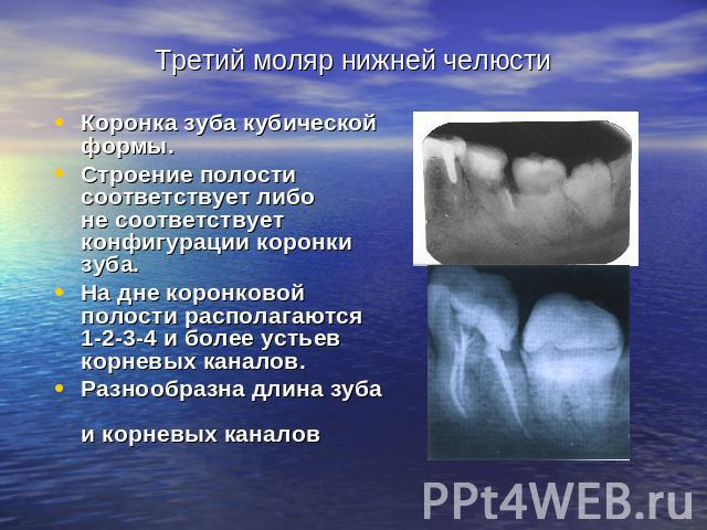 Третий моляр нижней челюсти Коронка зуба кубической формы. Строение полости соответствует либо не соответствует конфигурации коронки зуба. На дне коронковой полости располагаются 1-2-3-4 и более устьев корневых каналов. Разнообразна длина зуба и кор…