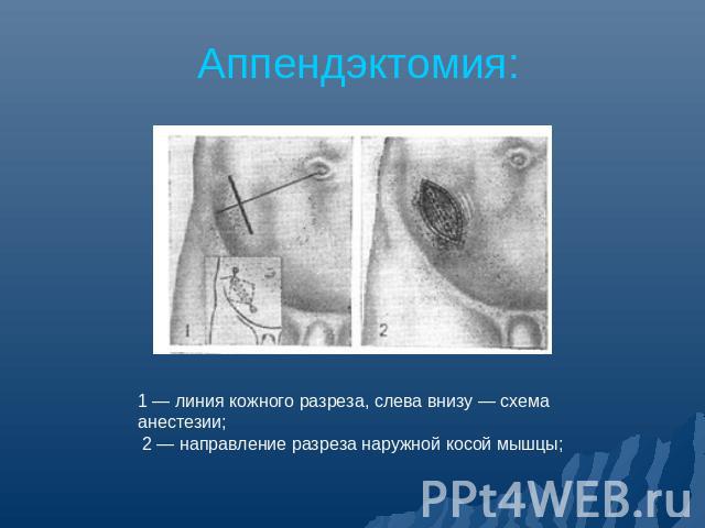 Аппендэктомия: 1 — линия кожного разреза, слева внизу — схема анестезии; 2 — направление разреза наружной косой мышцы;