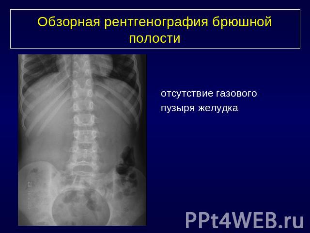 Обзорная рентгенография брюшной полостиотсутствие газового пузыря желудка