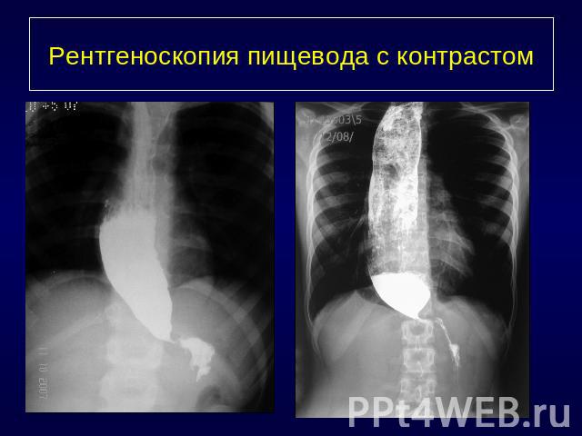 Рентгеноскопия пищевода с контрастом