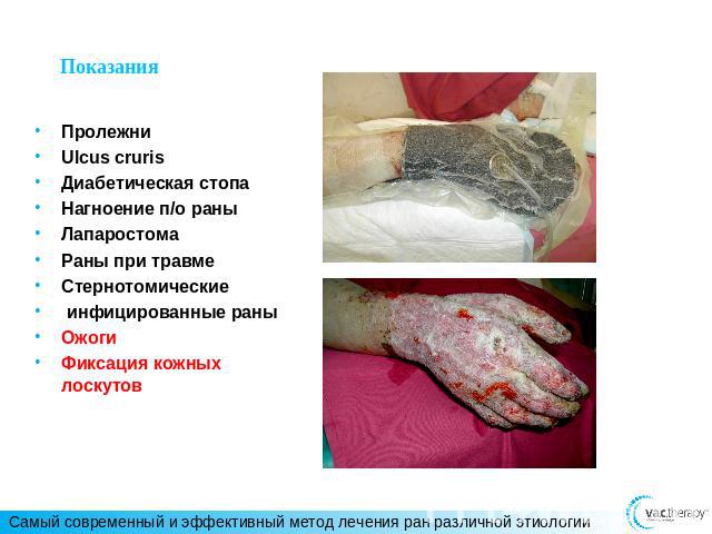 ПролежниUlcus crurisДиабетическая стопаНагноение п/о раныЛапаростомаРаны при травмеСтернотомические инфицированные раныОжогиФиксация кожных лоскутов