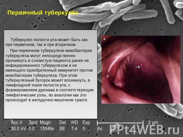Первичный туберкулёз Туберкулез полости рта может быть как при первичном, так и при вторичном. При первичном туберкулезе микобактерии туберкулеза могут непосредственно проникнуть в слизистую пациента ранее не инфицированного туберкулезом и не имеюще…