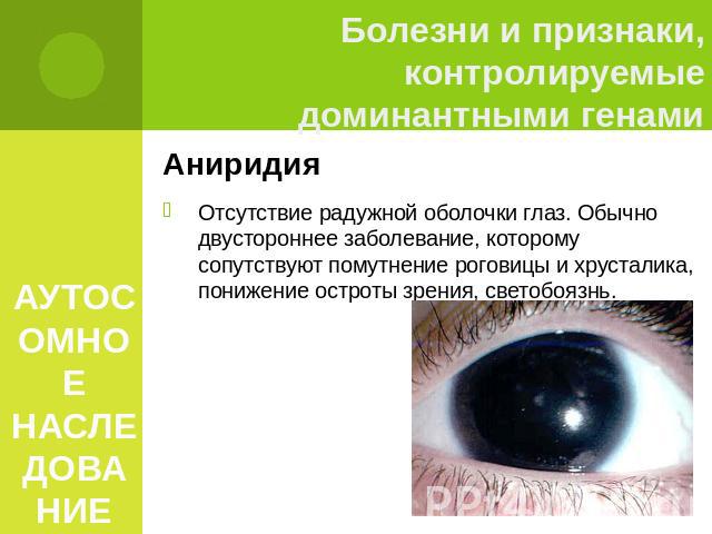 АУТОСОМНОЕ НАСЛЕДОВАНИЕ Аниридия Отсутствие радужной оболочки глаз. Обычно двустороннее заболевание, которому сопутствуют помутнение роговицы и хрусталика, понижение остроты зрения, светобоязнь.