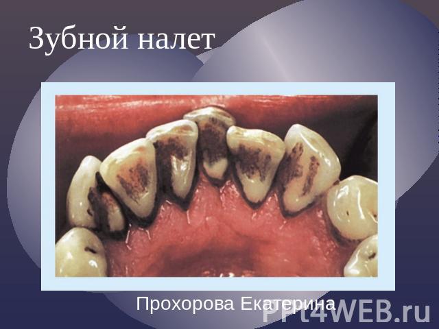Зубной налет Прохорова Екатерина