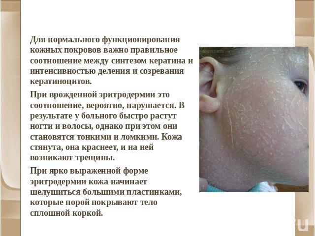 Эритродермия Для нормального функционирования кожных покровов важно правильное соотношение между синтезом кератина и интенсивностью деления и созревания кератиноцитов. При врожденной эритродермии это соотношение, вероятно, нарушается. В результате у…