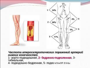 Частота атеросклеротических поражений артерий нижних конечностей.1- аорто-подвзд