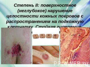 Степень II: поверхностное (неглубокое) нарушение целостности кожных покровов с р