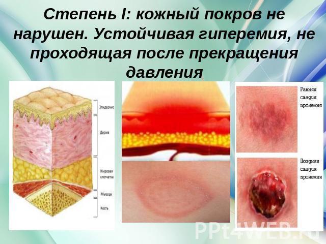Степень I: кожный покров не нарушен. Устойчивая гиперемия, не проходящая после прекращения давления