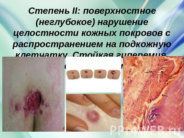Степень II: поверхностное (неглубокое) нарушение целостности кожных покровов с распространением на подкожную клетчатку. Стойкая гиперемия. Отслойка эпидермиса.