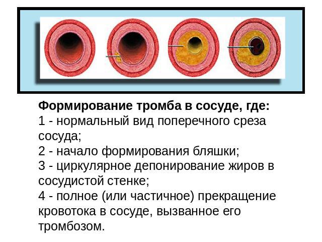 Формирование тромба в сосуде, где:1 - нормальный вид поперечного среза сосуда; 2 - начало формирования бляшки; 3 - циркулярное депонирование жиров в сосудистой стенке; 4 - полное (или частичное) прекращение кровотока в сосуде, вызванное его тромбозом. 