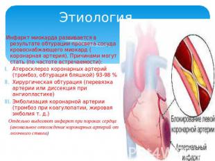 Этиология Инфаркт миокарда развивается в результате обтурации просвета сосуда кр