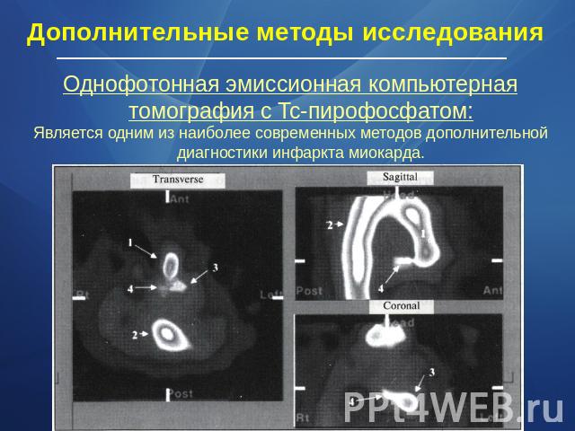 Дополнительные методы исследования Однофотонная эмиссионная компьютерная томография с Tc-пирофосфатом:Является одним из наиболее современных методов дополнительной диагностики инфаркта миокарда.