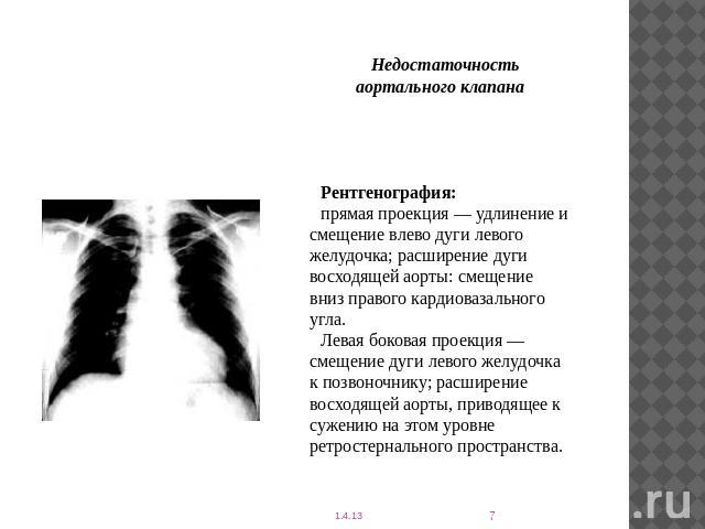 Недостаточность аортального клапанаРентгенография: прямая проекция — удлинение и смещение влево дуги левого желудочка; расширение дуги восходящей аорты: смещение вниз правого кардиовазального угла.Левая боковая проекция — смещение дуги левого желудо…