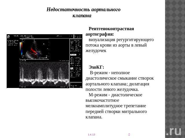 Недостаточность аортального клапана Рентгеноконтрастная аортография: визуализация регургитирующего потока крови из аорты в левый желудочекЭхоКГ: В-режим - неполное диастолическое смыкание створок аортального клапана; дилатация полости левого желудоч…