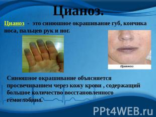 Цианоз. Цианоз - это синюшное окрашивание губ, кончика носа, пальцев рук и ног.