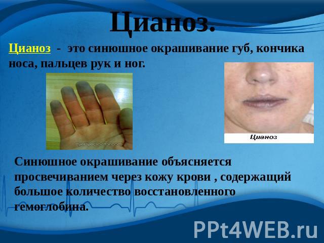 Цианоз. Цианоз - это синюшное окрашивание губ, кончика носа, пальцев рук и ног. Синюшное окрашивание объясняется просвечиванием через кожу крови , содержащий большое количество восстановленного гемоглобина.