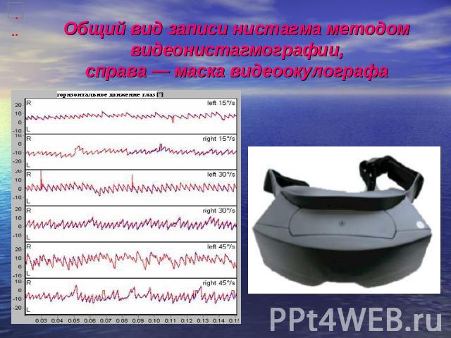 Общий вид записи нистагма методом видеонистагмографии,справа — маска видеоокулографа
