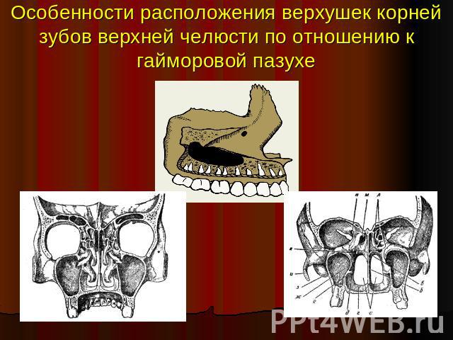 Особенности расположения верхушек корней зубов верхней челюсти по отношению к гайморовой пазухе