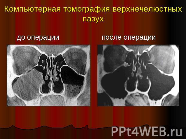 Компьютерная томография верхнечелюстных пазухдо операции до операции после операции