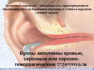 Буллезный мирингит – заболевание уха, характеризующееся образованием булл на бар