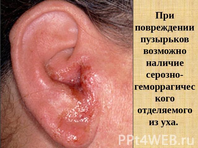 При повреждении пузырьков возможно наличие серозно-геморрагического отделяемого из уха.