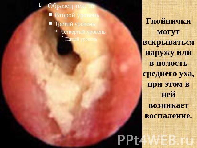 Гнойнички могут вскрываться наружу или в полость среднего уха, при этом в ней возникает воспаление.