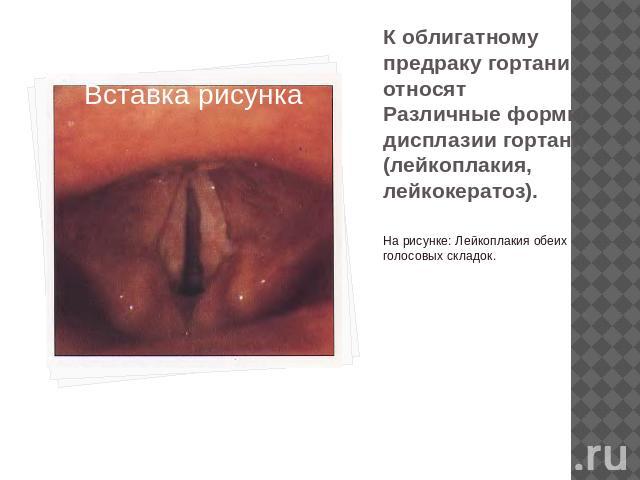 К облигатному предраку гортани относятРазличные формы дисплазии гортани (лейкоплакия, лейкокератоз). На рисунке: Лейкоплакия обеих голосовых складок.