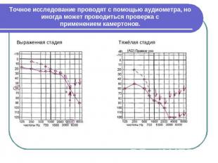 Точное исследование проводят с помощью аудиометра, но иногда может проводиться п