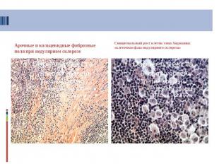 Арочные и кольцевидные фиброзные поля при нодулярном склерозе Синцитиальный рост