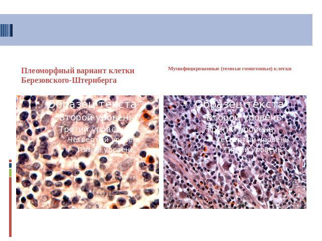 Плеоморфный вариант клетки Березовского-Штернберга Мумифицированные (темные гомогенные) клетки
