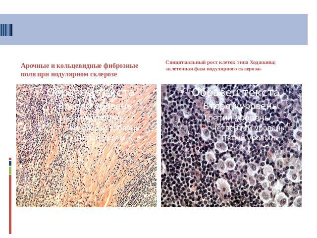 Арочные и кольцевидные фиброзные поля при нодулярном склерозе Синцитиальный рост клеток типа Ходжкина; «клеточная фаза нодулярного склероза»