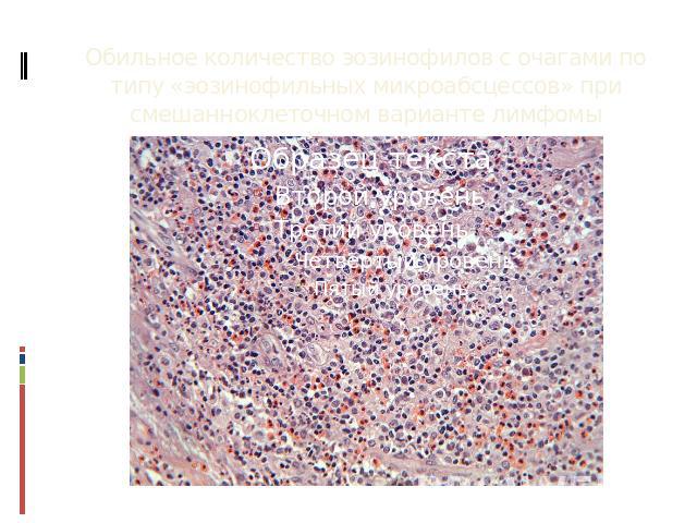 Обильное количество эозинофилов с очагами по типу «эозинофильных микроабсцессов» при смешанноклеточном варианте лимфомы Ходжкина