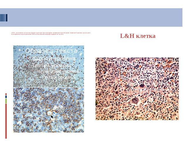 CD20 – позитивные клетки нодулярной структуры при нодулярном лимфоидном преобладании лимфомы Ходжкина: среди малых В-лимфоцитов нодуля единичная L&H клетка (нижняя микрофотография, на стрелке) L&H клетка