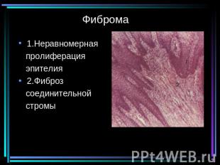 Фиброма 1.Неравномерная пролиферация эпителия2.Фиброз соединительной стромы