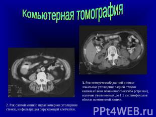 Комьютерная томография 2. Рак слепой кишки: неравномерное утолщение стенок, инфи